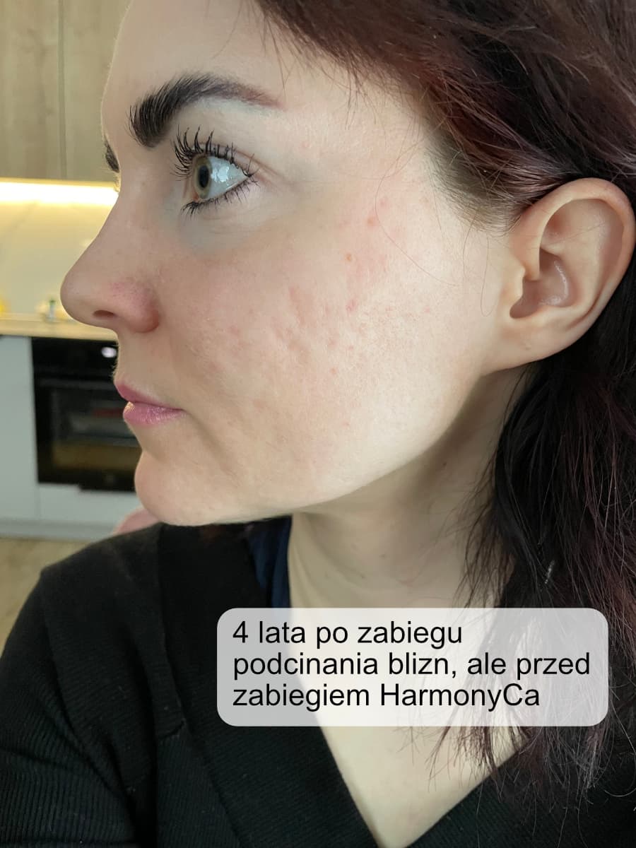 Jak pozbyć się blizn potrądzikowych? — materiał ilustracyjny